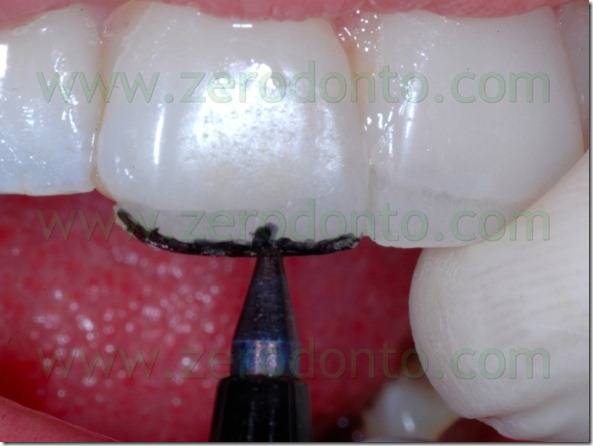 29 prove estetiche faccette