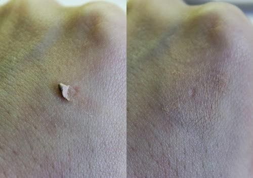 Decolorazione laser di risposte della pelle