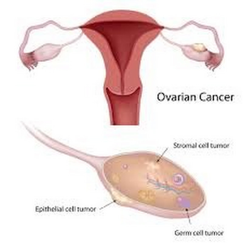 Cancerous and Benign Causes of Elevated CEA 125 Level