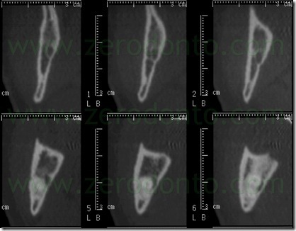 3 tac dente del giudizio