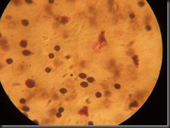 CLL high resolution histology slide tsnaps CLL high resolution histology slide tsnaps