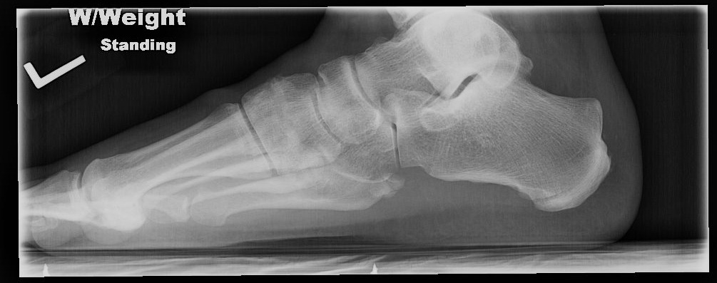 [Haglund%2527s%2520Deformity%255B4%255D.jpg]