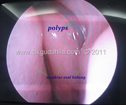 polyps dalam hidung polyps dalam hidung