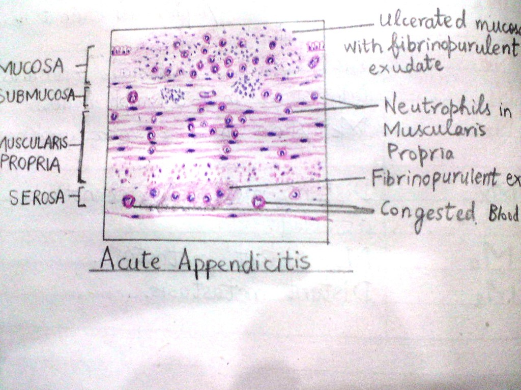 [acuteappendicitis22.jpg]
