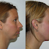 Chin3.png