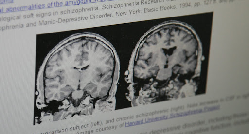 These images show how the ventricles of a person with Schizophrenia are enlarged. (Photo credit: Alex Crowder)