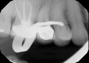 Endo Retx2.jpg