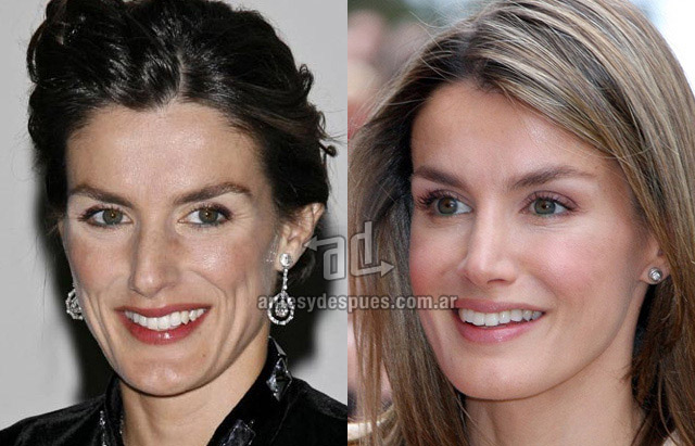 La nueva nariz operada de Letizia Ortiz