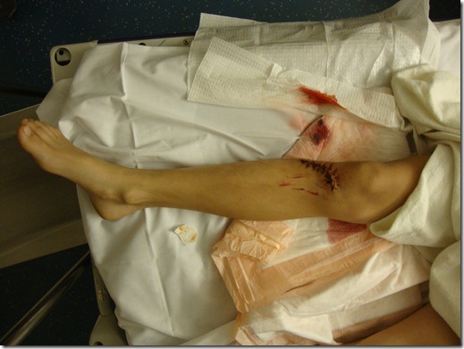 leg suture