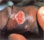 sifilis-primaria-pene-02.jpg