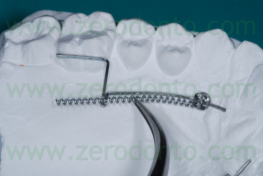 [19%2520coil%2520per%2520distalizzare%255B5%255D.jpg]