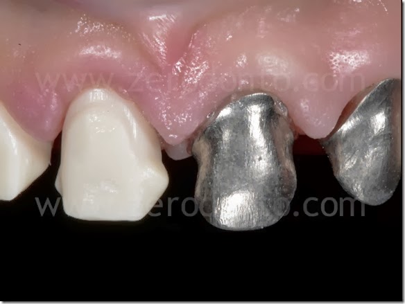 ABC Zirconia oro ceramica ABC Zirconia oro ceramica