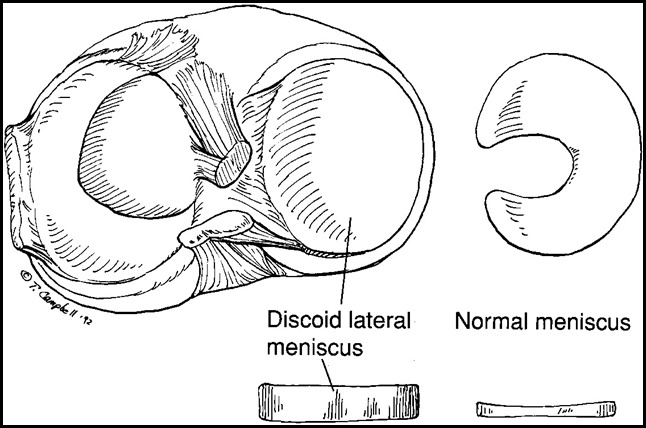 1289167845_discoid-meniscus 1289167845_discoid-meniscus