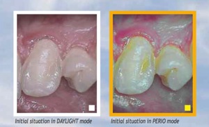 SoproCARE compare.jpg