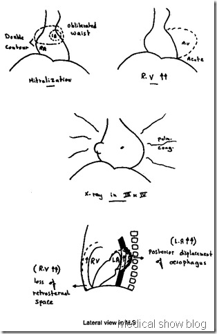 mitral stenosis medicalshow