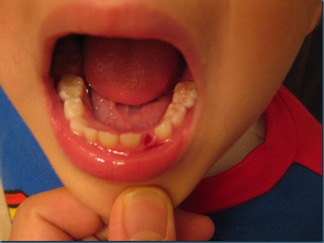 missing_tooth1