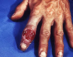 sifilis-en-dedos-mano.jpg