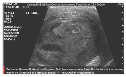 testicular ultrasound