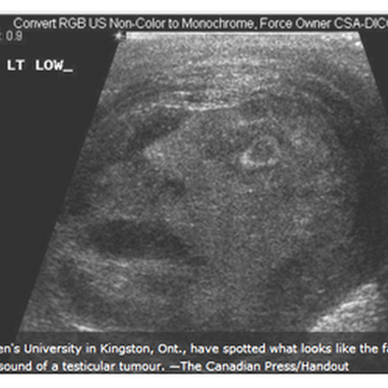 Screaming Man Seen in Testicular Ultrasound Dicom Image