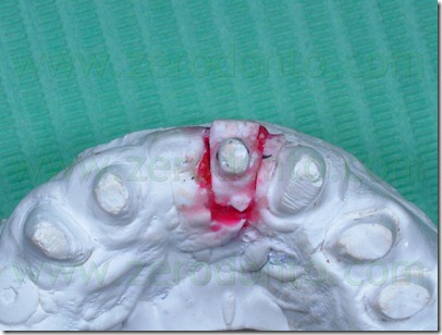 ortodonzia tipo invisalign con provvisorio