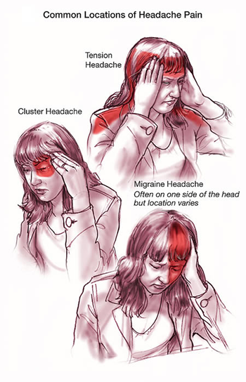 [Migraine-Headache%255B3%255D.png]