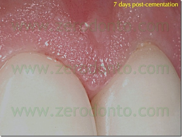 128 adattamento marginale faccette ceramica