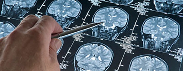 alzheimer_ml