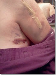 Surgery aftermath Surgery aftermath