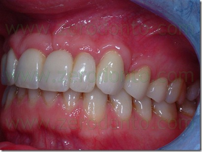 conore zirconia ceramica