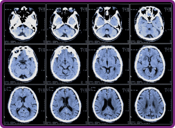 How Do You Notice and Prevent Concussions in Children
