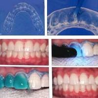 Técnicas de clareamento dental
