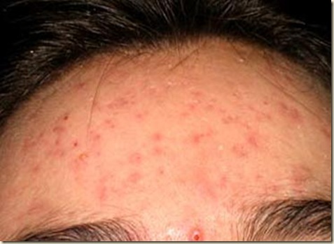acne14