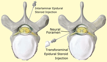 Types of lumbar epidural steroid injections