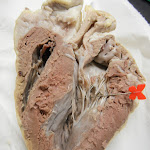 heart_ventricle_pin.JPG