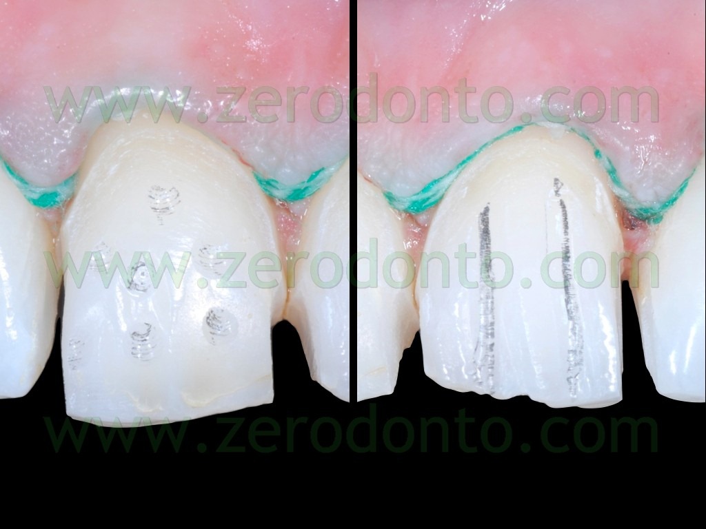 [56-tecniche-preparazione-faccette-an%255B2%255D.jpg]