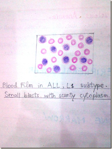ALL blood film diagram- hand made -haematology acute lymphoblastic leukemia