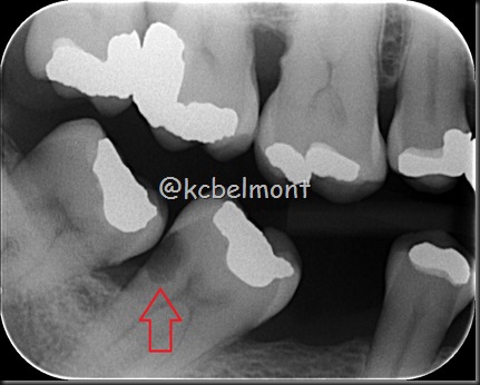 crie 47 interproximal