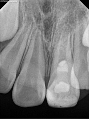 Open Apex at 6 months