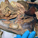 splenic_artery.JPG