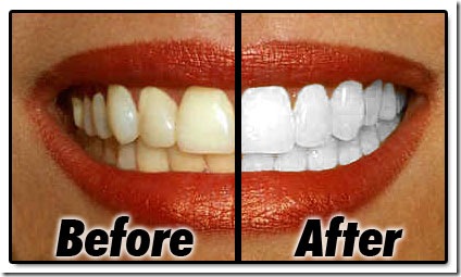 teeth whitening2