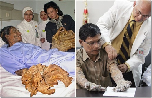 hombre arbol antes y despues (1)