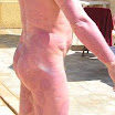 PlaquePsoriasis4.jpg