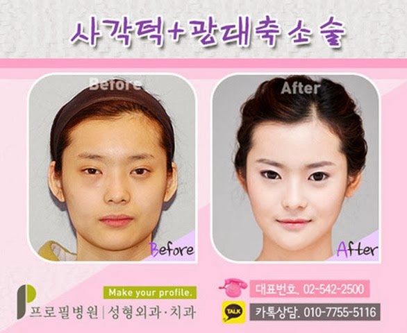[korean-plastic-surgery-12%255B2%255D.jpg]