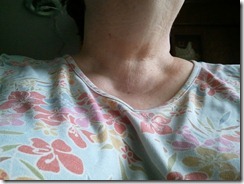 neck changes 28 months post-op