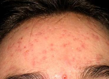 [acne-NTNVa%255B3%255D.jpg]