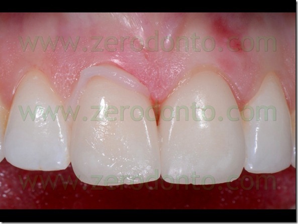 106 pasta prova idrosolubile cemento resinoso estetico veneers
