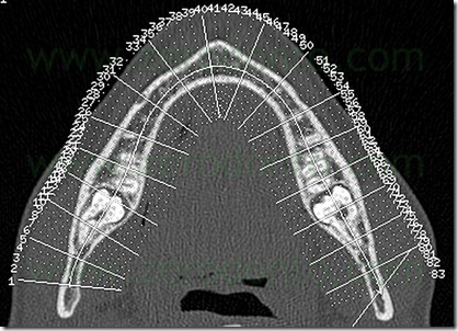 7 tac dente del giudizio inferiore 7 tac dente del giudizio inferiore