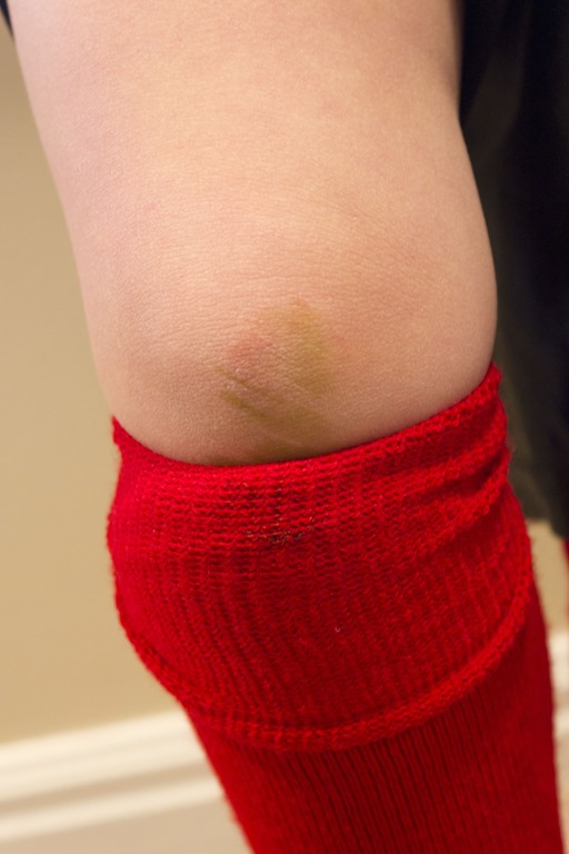 [scraped%2520knee.jpg]