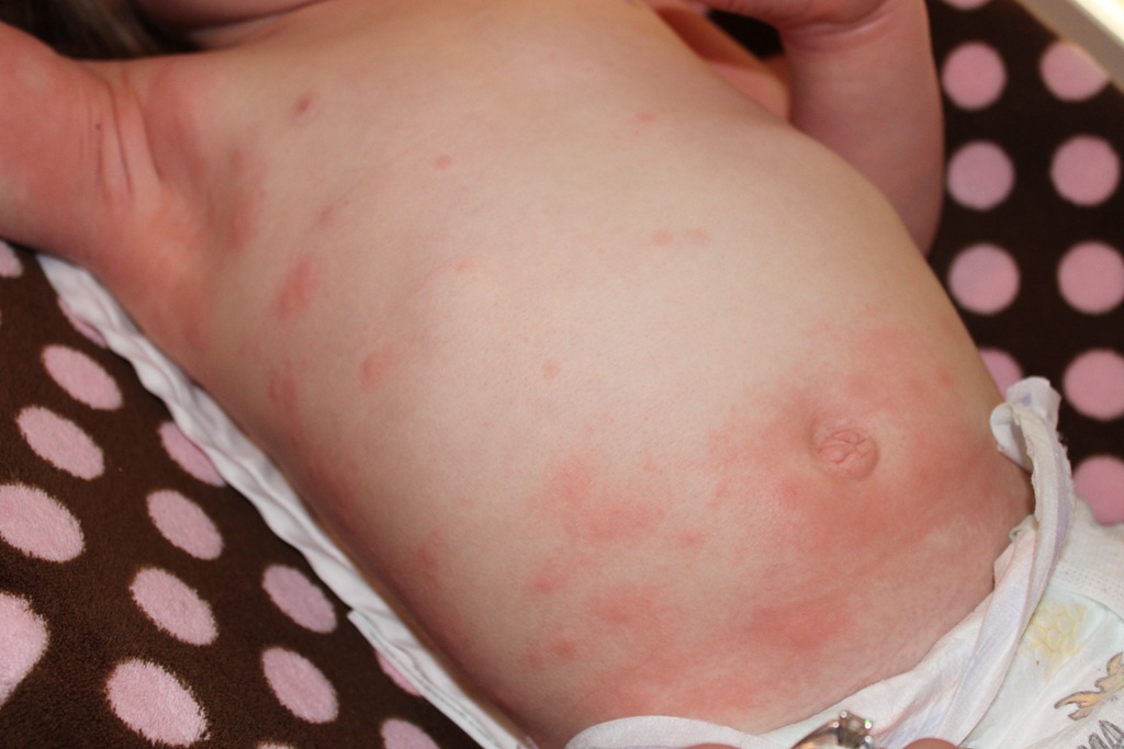 [2012-02-07%2520Hives%25201%255B4%255D.jpg]