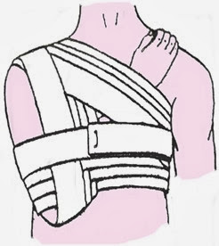Bandage de l’épaule